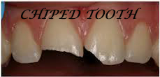 chiped tooth