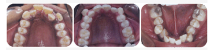 crowded anterior