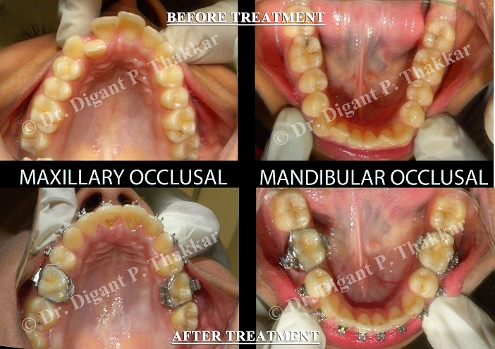 Orthodontic Treated cases